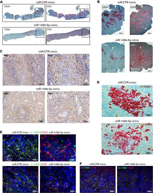 Treatment with miR-146b-5p mimic inhibits CLL growth, proliferation, and IL-12Rβ1 expression in the NSG mouse model. (A) Low magnification image (top) of longitudinal sections of paraffin-embedded mouse spleen (CLL GE1-PM129) stained for CD20 (left) or CD3 (right). The spleen from a mouse treated with miR CTR mimic (NSG13, top) or with miR-146b-5p mimic (NSG16, bottom) is represented. (B) Higher magnification (40×) of the areas of spleen highlighted by the boxes in (A) showing a decrease of neoplastic B cells (and not of T cells) in the follicular infiltrates after treatment with miR-146b-5p compared with control samples. (C) IHC analysis of Ki67+ cycling cells at 100× and 200× magnification in spleens of the same mice treated as indicated in (A). Decreased proliferating cells in the spleen infiltrate of mice treated with miR-146b-5p mimic (lower panels) compared with control samples (upper panels) is evident. (D) High magnification image (400×) of longitudinal sections of the spleens of the same mice as in (C) double-stained for CD20 and Ki67. (E) Double-marker immunofluorescence (IF) and confocal microscopy (high-magnification image 400×) analysis of IL-12Rβ1 chain and CD20 (upper panels) or CD3 chain (lower panels) and DAPI of the spleens of miR-CTR (NSG 14, left) or miR-146b-5p mimic-treated mice (NSG 5, right). (F) Double-marker IF and confocal microscopy (high-magnification 200×) analysis of IL-12Rβ1 chain and IL-23 or DAPI of a representative of the spleens of miR-CTR (NSG 14, upper panel) or miR-146b-5p mimic-treated mice (NSG 5, lower panel). IF microphotographs are representative of analyses of ≥5 low-power magnification (100×) or 10 high-power magnification (200× and 400×) microscopic fields performed on each mouse tissue sample.