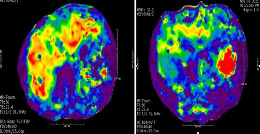 Magnetic resonance (MR) color elastogram with a 0 to 8 kPa scale in case 1 demonstrates increased liver stiffness with red and orange regions that show increased stiffness values instead of blue and purple regions with lower stiffness values. In the quantitative analyses, mean liver stiffness values were observed as 5.25 kPa before treatment (A) and 3.6 kPa after treatment (B). Of note, red and orange regions are decreased in the follow-up MR elastogram. Interpretation of MR elastography results: 2.5 kPa = normal; 2.5 to 3.0 kPa = normal or inflammation; 3.0 to 3.5 kPa = stage 1 to 2 fibrosis; 3.5 to 4 kPa = stage 2 to 3 fibrosis; 4 to 5 kPa = stage 3 to 4 fibrosis; and >5 kPa = stage 4 fibrosis.