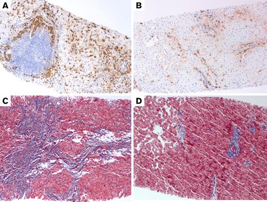Tryptase and trichrome stains of the liver in Case 1. (A) Pretreatment liver biopsy (100×) shows clustered MCs around a lymphoid nodule in the portal tract and increased spindled MCs in the lobule on tryptase immunostain. MCs constituted approximately 5% of the tissue. (B) Posttreatment liver biopsy (100×) shows much fewer MCs on tryptase immunostain (approximately 1% of the tissue). (C) Trichrome stain of the liver (100×) before treatment shows bridging fibrosis (with collagen staining blue) and early nodularity. (D) After treatment, trichrome stain of the liver (100×) shows improvement in fibrosis, now limited mainly to the portal tracts.