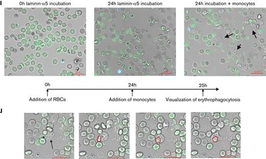 Laminin-α5–adherent uRBCs are characterized by elevated intracellular Ca2+levels. (A) Intracellular Ca2+ levels of malaria culture–derived uRBCs (MC) normalized to control RBCs (control). Mean ± standard error of the mean (SEM); n = 6. (B) Intracellular Ca2+ levels of RBCs incubated in malaria conditioned medium (CM) normalized to control RBCs (control). Mean ± SEM; n = 7. (C) Intracellular Ca2+ levels of uRBCs derived from patients with malaria and age-matched control. Mean ± standard deviation (SD); n = 5-6; Mann-Whitney test. (D) Normalized laminin-α5 adherence of RBCs exposed to CM, with or without BAPTA treatment. Mean ± SEM, n = 4. (E) Mean fluorescence intensities (MFI) of Fluo-4 from malaria culture uRBCs (y-axis) were plotted against laminin-α5 adherence normalized to that of control RBCs (x-axis; n = 18). (F) Fluo-4–stained RBCs from control-, MC-, and CM-incubated RBCs were passed over laminin-α5–coated Ibidi μ-slides at a flow rate of 0.2 dyn/cm. Laminin-α5–bound RBCs were quantified and analyzed for Fluo-4 positivity by Arivis Vision 4D image analysis software. iRBCs were assessed by Hoechst staining. Mean ± SEM, n = 3-6. (G) uRBC ghosts were identified as spherical translucent Hoechst-negative cells and quantified over the course of 20 hours. Mean ± SEM; n = 4. (H) Ca2+ permeability of control RBCs (i), ionomycin-treated RBCs (ii), malaria cultured RBCs (iii), and RBCs incubated in malaria CM (iv) after 8 hours of experimental measurement. RBCs were stained for intracellular Ca2+ by Fluo-4 (green) and Hoechst (blue) for iRBC detection. (I) Representative microscopy images of RBCs incubated with iRBCs on laminin-α5–coated microscopic chambers at 0 hours of laminin-α5 incubation. Monocytes (arrows) were added after a 24-hour laminin-α5 incubation to carboxyfluorescein diacetate succinimidyl ester–stained RBCs (green), hemolyzed uRBCs (∗) and Hoechst-stained iRBCs (blue). (J) Phagocytosis of hemolyzed uRBCs (∗) by unstained monocytes (arrow) when co-incubated with iRBCs on laminin-α5–coated microscopic chambers. Red outlines show uRBC uptake by monocytes. Images in panels H, I, and J were obtained under a ×40 oil-immersion objective. Bars represent 20 μm. Wilcoxon matched-pairs signed-rank test, unless stated otherwise. Error bars denote SEM or SD.