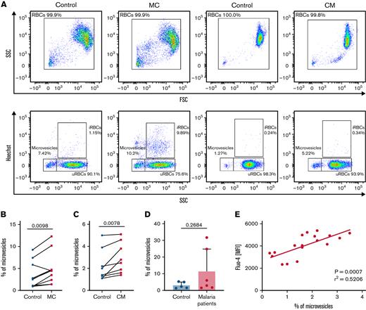 Increased vesiculation of MC uRBCs and condition medium–exposed RBCs is associated with laminin-α5 interaction. (A) Microvesicles were characterized as Hoechst-negative cells corresponding to a low side scatter (SSC) and were quantified in control, malaria culture (MC), and conditioned-medium (CM) samples. Selected fluorescence-activated cell sorting (FACS) plots are representative of 8 to 10 biological replicates. (B) Flow cytometric quantification of microvesicles in control RBCs (control) and in MC RBCs. n = 8. (C) Percentage of microvesicles in control RBCs (control) and in CM-exposed RBCs. n = 8. Wilcoxon matched-pairs signed rank test. (D) Percentage of microvesicles in samples from patients with malaria and age-matched controls. Mean ± SD; n = 5-6; Mann-Whitney test. (E) Mean florescence intensities (MFI) of Fluo-4–stained uRBCs from CM-incubated RBCs (y-axis) were plotted against the percentage of microvesicles (x-axis; n = 18); 95% confidence interval, 0.3841-0.8890.