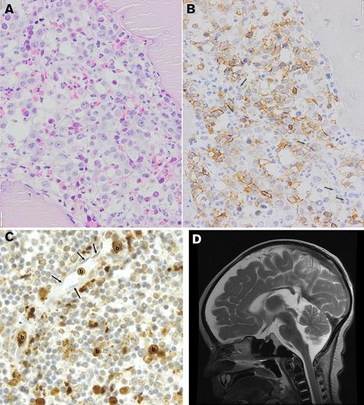 The presence of major symptoms in DHFR deficiency. (A) Bone marrow biopsy showing a severely impaired erythroid outgrowth and a myeloid differentiation defect with marked megaloblastic features (hematoxylin and eosin; bar, 20 μm). (B) Immunohistochemistry with antiglycophorin A, demonstrating the presence of multiple megaloblasts and an almost complete absence of late-stage erythroid precursors. Among the unstained (myeloid) cells, several giant bands are identified (arrows). (C) AML was suggested in the second case. Immunohistochemically stained slide of the spleen. CD33-positive blasts marked as (b) can be observed in lytic tissue of the spleen. Some of these blasts are located in capillaries. The nuclei of the endothelial cells lining the wall of these capillaries are indicated with an arrow. Similar infiltration of MPO/CD33+ myeloid blasts was observed in the liver and bone marrow. The child died at presentation in the emergency room. The diagnosis of infantile AML was made post mortem from the obtained autopsy samples. (D) T2 magnetic resonance imaging in patient 3 demonstrating both cerebral and cerebellar atrophy and hypoplasia of the cerebellar vermis.