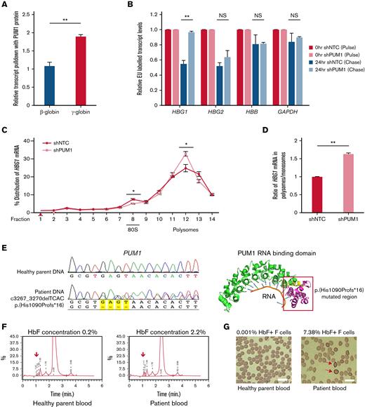 PUM1 binds to γ-globin mRNA and decreases γ-globin (HBG1) mRNA stability and translational efficiency, and the blood from an individual harboring a novel heterozygous mutation in PUM1 RNA-binding domain displays elevated percentages of HbF and F cells. (A) qRT-PCR analysis of RNA levels of the indicated transcripts in the immunoprecipitated eluates after RIP of PUM1 in HUDEP2 cells (n = 4). Bar graphs show mean ± standard error of the mean. (B) qRT-PCR analysis of 5-EU incorporated mRNAs of indicated genes at 0-hour pulse and 24-hour chase time points after incorporation in HUDEP2 cells infected with either PUM1 or NTC lentiviral shRNAs showed an increase in the stability of HBG1 but not HBG2 or HBB globins at the 24-hour time point upon PUM1 knockdown (n = 2). Bar graphs show mean ± SD. (C) Polysome fraction analysis in HUDEP2 cells infected with either PUM1 or NTC lentiviral shRNAs showing relative distribution of HBG1 mRNA in each of the 14 fractions. Fraction 8 corresponds to the monosome fraction (80S), whereas fractions 10 to 14 correspond to the polysome fractions. A decrease in the distribution of HBG1 mRNA in the monosomal fraction with a corresponding increase in the polysomal fraction was observed upon PUM1 knockdown, suggesting an increase in translational efficiency in these samples. (D) Ratio of the polysomes (mRNA pooled from fractions 10 to 12) to the monosomes (mRNA in fraction 8) in the polysome fraction analysis in panel C is shown (n = 2). Bar graphs show mean ± SD. (E) Left: DNA sequencing chromatogram of the blood from a patient with PUM1-associated developmental disability, ataxia, and seizure (PADDAS) who has a novel heterozygous mutation (c.3267_3270delTCAC) and normal (parent) blood. Right: The structure of the RNA-binding domain of PUM1 bound to RNA. The region altered by the mutation p.(His1090Profs∗16) is shown in yellow and magenta. (F) HPLC analysis of Hb. Red arrows indicate HbF levels. (G) F cells were stained by using a modified Kleihauer-Betke procedure in the blood of a patient with PADDAS and normal (parent) blood. Red arrows indicate the F cells. Data were analyzed by using a two-sided Student t test. Scale bar represents 30 μm. ∗P < .05; ∗∗P < .005.