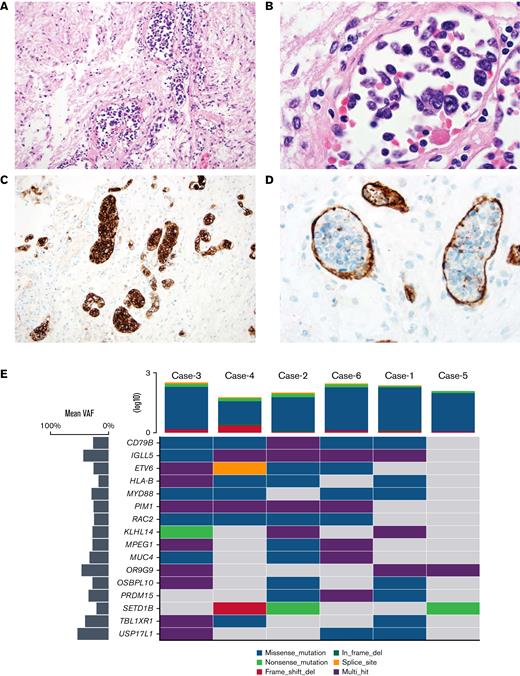 Histopathology and recurrent SNVs in IVLBCL. (A) H&E-stained section of the pituitary from case no. 4, which had a RAC2 switch 2 domain mutation p. R68Q (NM 002872.5) (×20 original magnification shows large, atypical lymphocytes within sized vessels). (B) High-power H&E image showing large, atypical lymphocytes within the vascular lumen (×100 original magnification). (C) A CD20 immunostain demonstrates large intravascular B cells (×20 original magnification). (D) A CD34 immunostain confirms that large cells are confined to the vascular lumen (×60 original magnification). (E) Oncoplot24 showing top cooccurring mutations detected in 6 patients with IVLBCL. Horizontal lines represent genes, and the vertical line indicates a single patient. The type of mutations is color-coded in the legend. Mean variant allele frequency for each gene is depicted in the bar plot on the left-hand side. The tumor mutation burden (TMB) for each patient is represented on the upper side of the plot. H&E, hematoxylin and eosin.