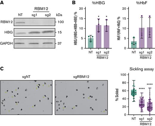 RBM12 depletion in CD34+HSPCs derived from patients with SCD. CD34+ HSPCs isolated from apheresis waste product of 3 patients with SCD targeted with 2 independent RBM12 sgRNAs along with an NT control. (A) Western blot analysis with indicated antibodies at day 10 of differentiation. (B) HbF induction assayed via qRT-PCR and high-performance liquid chromatography. Plotted are means ± standard deviation (n = 3). ∗P < .05 by Student’s t test. Left: qRT-PCR of HBG1/2 mRNA as percentage of total β-like globin transcripts at day 12 of differentiation. Results are normalized to HPRT1. Right: High-performance liquid chromatography at day 15 of differentiation. (C) Left: Representative images of sickling assay results. Sickled cells are indicated by yellow arrows. Original magnification ×40 on an Olympus BX40 microscope fitted with an Infinity Lite B camera (Olympus) and the coupled image capture software. Right: Quantification of percent sickled cells. Each dot represents a distinct field of view. Each sample has approximately 1000 total cells quantified. ∗∗∗∗P < .0001 by Student’s t test.