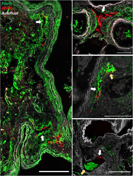 Fibrin clots in lymphatic vessels in lungs of COVID-19 decedents. Representative immunofluorescence images of lung sections showing fibrin (green) and podoplanin+ LECs (red) with 488 autofluorescence (gray) to show tissue structure. Yellow arrows indicate clotted lymphatic vessels, and white arrows indicate damaged lymphatic endothelium. Scale bars, 100 μm.