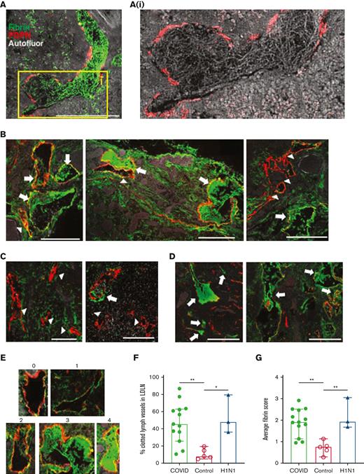 Lymphatic clotting is widespread in LDLNs of COVID-19 decedents. (A) Representative immunofluorescence image showing a large lymphatic clot in an LDLN section with fibrin (green) and podoplanin (red), with inset (Ai) highlighting the fibrillar structure of the fibrin clot in 488 autofluorescence (gray). (B-D) Representative images showing intralymphatic fibrin clots in LDLNs of (B) COVID-19 decedents, (C) control decedents without viral infections, and (D) H1N1 decedents, with arrows indicating partially or fully clotted vessels and arrowheads indicating open vessels. Scale bars in panels A-D, 100 μm. (E) Lymphatic clotting score rubric showing examples for each score: 0, no fibrin (fully open); 1, fibrin confined to endothelium; 2, minimal intralymphatic fibrin (<20% of vessel lumen); 3, partially occluded (>20% of lumen); and 4, fully occluded. (F) Percentage of clotted lymphatic vessels (with a fibrin score of 3-4) in LDLNs from COVID-19, control, and H1N1 decedents; each dot shows the average from 3 sections of each patient. (G) Average lymphatic fibrin score in each LDLN. Bars in panels F-G represent median ±95% confidence interval; ∗P < .05, ∗∗P < .01 by one-way ANOVA with Tukey multiple comparisons post-test.