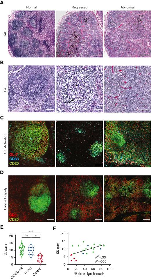 Abnormal GC architecture in LDLNs of COVID-19 decedents correlates with lymphatic clotting in LDLN. (A-D) Representative images from stained LDLNs comparing features of normal (left), regressed (middle), and otherwise abnormal (right) GC follicles of COVID-19 and control decedents. (A) H&E-stained tiled images where the abnormal (right) lacks secondary follicle formation altogether. (B) Zoomed-in H&E-stained images showing a normal secondary follicle (left), a regressed follicle lacking a mantle zone and containing TBMs (black arrows) (middle), and complete lack of follicle architecture (right). (C) Representative immunofluorescence images showing lymphocyte activation in control (left) and COVID-19 (middle and right) LDLNs; CD83 (cyan), GL7 (red), and CD20 (green). The left panel shows strong follicle formation and activation, the middle panel shows decreased follicle size and density, and the right panel shows abnormal follicle structure and extensive extrafollicular activation. (D) Representative immunofluorescence images of T-cell (CD3, red) and B-cell (CD20, green) zone integrity in COVID-19 LDLNs. The left panel shows dense B cells and distinct T-cell and B-cell separation, whereas the middle panel shows decreased follicle size and density, and the right panel shows decreased cellularity and poor T-cell and B-cell zone integrity. (E) Average GC abnormality scores for LDLNs of COVID-19, H1N1, and control decedents. Dashed line represents the median for each group, and dotted lines represent the first and third quartiles. ∗∗∗P < .001, one-way ANOVA test with Tukey multiple comparisons test. (F) Linear regression correlations of GC abnormality score vs percentage of clotted lymphatic vessels in LDLNs from COVID-19 (black), H1N1 (blue), and control (red) decedents. Scale bars, 500 μm (A) and 100 μm (B-D).