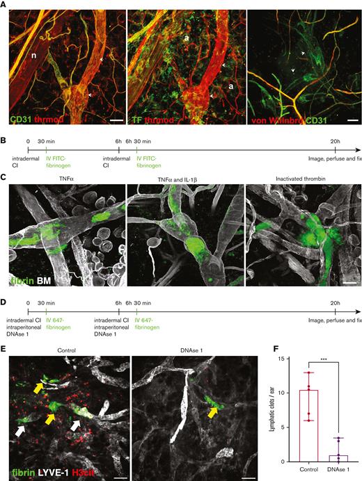 Local injection of TNF-α or inactivated thrombin induces NET-dependent intralymphatic fibrin coagulation and blocks lymphatic drainage in mouse skin. (A) Representative immunofluorescence images of thrombomodulin (thrmod, red), CD31 (green), tissue factor (TF, green), and von Willebrand factor (von Willnbrd, red) staining in mouse ears. Arrows point to collecting lymphatics that contain unique morphological features (ie, valves with uneven vessel diameters). Thrombomodulin expression overlaps with CD31 and is also present in some interstitial and perivascular cells and nerve fibers (left) (n). Both blood and lymphatic vessels express thrombomodulin, but only blood vessels express TF (middle). TF expression in lymphatics is limited to perivascular cells and adipocytes (A). In contrast to blood vessels, lymphatic vessels did not express von Willebrand factor (right). Scale bars, 50 μm. (B) Schematic of experimental design: intradermal injection of clot initiators (CIs) TNF-α, TNF-α and IL-1β, or inactivated thrombin, on day 0 was followed by IV injection of FITC-labeled fibrinogen 30 minutes later. Six hours after the first injection, the procedure was repeated. The mice were perfused and fixed after 20 hours. (C) Representative confocal whole-mount images of lymphatic collectors occluded by fibrin (green) clots after treatment with TNF-α (left), TNF-α and IL-1β (middle), or inactivated thrombin (right). Basement membrane (BM, gray) is represented by collagen-IV staining. Scale bars, 50 μm. (D) Schematic of experimental design: intradermal injection of clot initiator (TNF-α) and intraperitoneal injection of DNase I on day 0 was followed by IV injection of 647-labeled fibrinogen 30 minutes later. Six hours after the first injection, the procedure was repeated, and the mice were perfused and fixed after 20 hours. Control mice received TNF-α but not DNase I injections. (E) Representative whole-mount immunofluorescence staining images of lymphatic vessels and clots in the mouse ear in control mice (left) and mice that received DNase I injections (right) (LYVE-1, white; H3cit, red; fibrinogen, green). White arrows indicate lymphatic clots (left inset: LYVE-1 and H3cit channels of clot containing NETs; right inset: LYVE-1 and H3cit channels of clot outside of a lymphatic with no NETs), and yellow arrows indicate clots outside of lymphatics, likely in a blood vessel. Scale bar, 100 μm. (F) Averaged number of lymphatic clots in the left and right ear dorsal dermis for each mouse injected intradermally with TNF-α (n = 5) and each mouse injected with both TNF-α and DNase I (n = 5). Bars and error bars represent median and 95% confidence interval, respectively. ∗∗∗P < .001 by unpaired two-tailed t test.