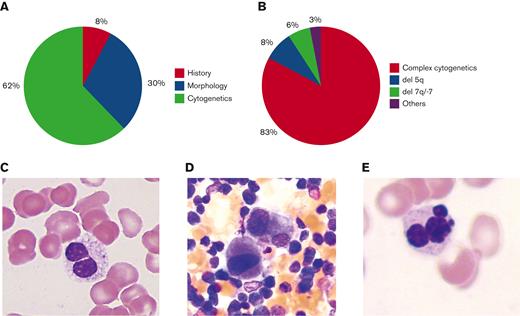 AML-MRC diagnosis. (A) Percentage of cases diagnosed based on morphology, history, or MDS-associated cytogenetics. (B) Percentage distribution of MDS-associated cytogenetic abnormalities. (C) Pseudo-Pelger-Huet cell. (D) Dysplastic monolobated megakaryocytes and megakaryocytes with separated nuclear lobes. (E) Dysplastic multinucleated erythroid cell. Original magnification ×1000 for panels C-E.