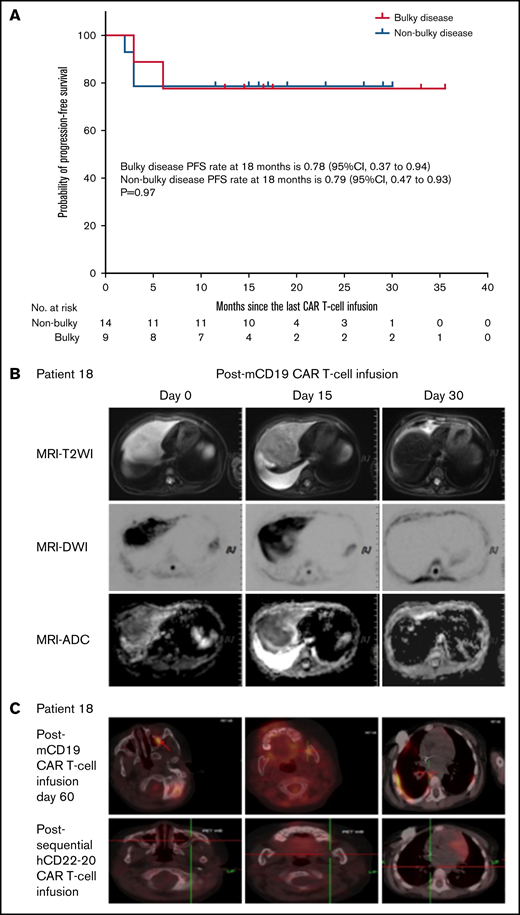 Efficacy of sequential CAR T-cell infusion in 9 patients with bulky disease. (A) The median PFS rate was not reached with an estimated 18-month PFS rate of 78% (95% CI, 37%-94%) in the patients with bulky disease, and no significant difference was observed in the estimated 18-month PFS rate between the group of patients with bulky disease and the group of patients with non-bulky disease (P = .97). (B) Magnetic resonance imaging (MRI) scans for P18 demonstrated CR of the mass on day 30 after edema of the mass on day 15 following mCD19 CAR T-cell infusion. (C) Positron emission tomography/computed tomography scans of P18 revealed the emergence of new lesions at multiple sites on day 60 after mCD19 CAR T-cell infusion and then CR2 through sequential hCD22 and hCD20 CAR T-cell infusions. ADC, apparent diffusion coefficient; DWI, diffusion weighted imaging; T2WI, T2-weighted imaging.