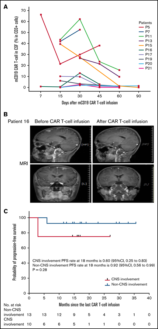 Efficacy of sequential CAR T-cell infusions in 10 patients with CNS involvement. (A) CD19 CAR T-cell expansion in the cerebrospinal fluid (CSF) of 10 patients with CNS involvement. (B) The MRI scans demonstrate that the mass beneath the leptomeningeum of P16 disappeared completely after mCD19 CAR T-cell infusion. (C) PFS after sequential CAR T-cell infusion. The median PFS rate was not reached; the estimated 18-month PFS rate was 60% (95% CI, 25%-83%) in patients with CNS involvement, which was not significantly lower than that in patients with no CNS involvement (P = .28).