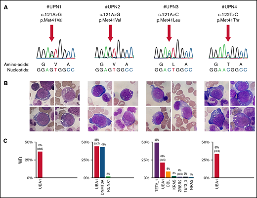 Molecular and cytomorphologic diagnosis in patients with VEXAS syndrome. (A) The Sanger sequencing chromatograms for the UBA1 (NM_0033334) mutations: c.121 A>G, p.Met41Val (n = 2); c.121 A>C, p.Met41Leu (n = 1); c.122 T>C, p.Met41Thr (n = 1). (B) Characteristic vacuoles in erythroid and granulocytic precursor cells in BM from all UBA1-mutated patients (May-Grümwald-Giemsa stain). (C) Variant allele frequencies (VAFs) for putative somatic variants identified by high-throughput sequencing. Because of their location on the X chromosome, VAFs for UBA1 (black boxes) and ZRSR2 are divided by 2 to allow their representation on the same graph. UPN, unit patient number.