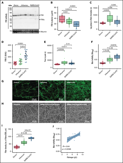 Formation of dense fibrin clots in plasma of patients with severe COVID-19. (A) Western blot analysis of factor XII in plasma of patients with ARDS-influenza (Influenza) or COVID-19 (SARS-CoV-2), as well as donors. Data from 4 of 21 patients with COVID-19, 4 of 25 patients with ARDS-influenza, and 3 of 21 donors are shown. Albumin was used as the loading control. (B) FXII levels in plasma of patients with ARDS-influenza (n = 25) or COVID-19 (n = 21) and donors (n = 16) as assessed by enzyme-linked immunosorbent assay. (C) Lag phase in fibrin formation triggered by kaolin. Influenza, n = 19; SARS-CoV-2, n = 20; donor, n = 20. (D) FVIII activity (FVIII:C) in plasma of patients and donors. Influenza, n = 19; SARS-CoV-2, n = 20; donor, n = 20. (E-F) Time to reach the turbidity peak (E) and maximum (Max) turbidity (F) values for influenza (n = 19), SARS-CoV-2 (n = 20), and donor (n = 20) plasma. Clot formation was induced by the addition of kaolin to plasma. (G) Representative laser scanning confocal microscopy images of fibrin fibers in clots formed from influenza (n = 19), SARS-CoV-2 (n = 20), and donor (n = 20) plasma. Fibrin fibers were stained with an anti-fibrinogen/fibrin antibody followed by an Alexa Fluor 488-conjugated secondary antibody. (H) Representative scanning electron microscopy images of fibrin network in clots generated from influenza plasma (n = 5) as well as low- and high-fibrinogen SARS-CoV-2 (n = 5 per group) plasma. (I) Fibrin fiber density in donor (n = 20), ARDS-influenza (n = 19), and COVID-19 (n = 20) clots. From each patient, 3 separate clots were prepared, 5 images were taken in different areas of the clots, and fibril density was determined in all images. (J) Correlation between maximum turbidity values and fibrinogen levels in plasma of patients with COVID-19 (n = 15; those patients with available fibrinogen levels were included into the analysis). Correlation was performed according to Spearman’s rank correlation coefficient.