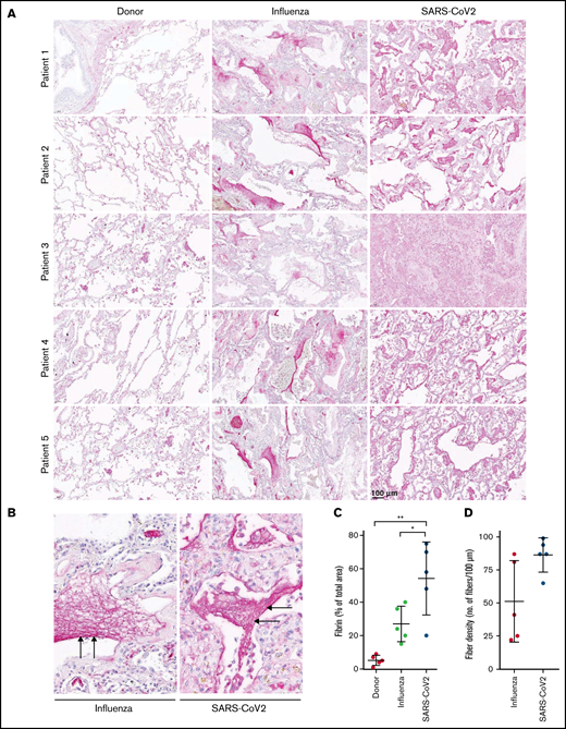 High abundance of fibrin deposits in the lungs of patients with severe COVID-19. (A-B) Fibrin (red) accumulation in postmortem lung tissue sections of patients with severe COVID-19 or ARDS-influenza and donors (n = 5/group). Time from death to autopsy was matched for all groups examined. Bar represents 100 µm. (B) Randomly chosen high-magnification images of the COVID-19 and ARDS-influenza clots presented in panel A. Arrows indicate fibrin deposits. All patients available are represented. Fibrin fibers were stained with an anti-fibrinogen/fibrin antibody and then developed by incubation with fast red dye. (C) Fibrin abundance in COVID-19, ARDS-influenza, and donor lungs. From each patient, 5 images were obtained in different areas of the lung, and the percentage of total area was determined in all images (n = 5 per group). *P < .05; **P < .01. (D) Fibrin fiber density in COVID-19 and ARDS-influenza lungs. From each patient, 5 images of fibrin deposits were taken, and fibril density was determined in all of them (n = 5 per group).