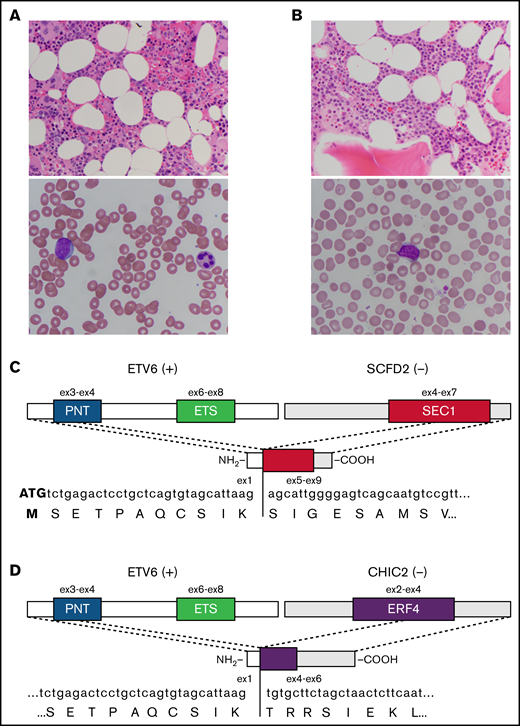 Representative pathology and schematics of in-frame fusion transcripts. (A) Representative BM histology (original magnification ×400; hematoxylin and eosin stain) (upper panel) and blast morphology on peripheral blood smear (original magnification ×1000; Wright-Giemsa stain) (lower panel) from patient 1. (B) Representative BM histology (original magnification ×400; hematoxylin and eosin stain) (upper panel) and blast morphology on peripheral blood smear (original magnification ×1000; Wright-Giemsa stain) (lower panel) from patient 2. (C) Schematic diagram of the in-frame ETV6-SCFD2 fusion identified in patients 1 and 2. Exon 1 of ETV6 is upstream of exons 5 through 9 of SCFD2, which includes part of the SEC1 domain sequence (exons 4-7). The fusion transcript does not contain the coding sequence for the PNT or ETS domains. (D) Schematic diagram of the in-frame ETV6-CHIC2 fusion identified in patient 3. Exon 1 of ETV6 is upstream of exons 4 through 6 of CHIC2, which includes the distal portion of the ERF4 domain sequence (exons 2-4). As above, the PNT and ETS domains are not included in the fusion transcript. +, positive strand gene; −, negative strand gene.