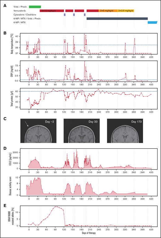 Clinical improvement is linked directly to the administration of vemurafenib. (A) Drug therapy of the first 420 days (60 weeks, start: day 0); vemurafenib was started on day 37 because of the worsening clinical condition during stratum I (vinblastine/prednisone), paused during initial salvage therapy of stratum III (2-CdA/Ara-C), and reduced in dose in 2 stages and discontinued during continuation therapy part 2 (6-MP/MTX/vinblastine/prednisone). Subsequently, continuation therapy part 3 (6-MP/MTX) was carried out until day 730 (supplemental Figure 1). (B) Vemurafenib resulted in immediate improvement in fever, CRP, and TP. Each cessation of vemurafenib during the chemotherapy cycles caused intermittent fever, rise in CRP, and falling levels of TP, which reversed on continuation. (C) MRT of cranial lesions, which decreased in size visibly already during therapy with vinblastine/prednisone (T1-weighted MRI). (D) CC-chemokine ligand 2 (CCL2) concentration was closely correlated with clinical signs of disease activity. Points represent the median, and error bars the top and bottom of triplicate measurements per time point. The LCH disease activity score (DAS), which stayed high during initial chemotherapy, immediately improved on start with vemurafenib. It is important to note that the DAS after 2-CdA/Ara-C is confounded by chemotherapy-induced cytopenia. (E) During vemurafenib therapy, the percentage of BRAFV600E mutant alleles increased. Following stratum III therapy, no more mutant alleles were measurable.