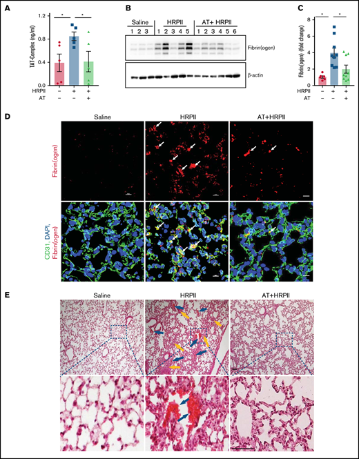 AT inhibits HRPII-mediated procoagulant responses in mice. Mice were injected IP with saline or HRPII (10 µg/g) and AT (20 µg/g) followed by taking blood samples and collecting organs after 3.5 hours for analysis. (A) Plasma level of the TAT complex was measured with established ELISA. (B) Perfused lower right lobe of the lung was harvested in the tissue lysis buffer and immunoblotted for fibrin(ogen). (C) Densitometric analysis of fibrin(ogen) deposition in the lung tissue sample is presented. (D) Lung cryosections were fixed, permeabilized, and incubated with anti-CD31 (rat) and anti-fibrin(ogen) (rabbit) antibodies followed by Alexa Fluor 488-conjugated anti-rat and Alexa Fluor 562-conjugated anti-rabbit antibodies. DAPI was used to stain the nucleus. The arrows indicate intravascular thrombosis. (E) Perfused upper left lobe of the lung was collected and processed for histological analysis. Paraffin-embedded sections of the lung tissue were stained with hematoxylin and eosin. Inset boxes from each group are magnified. Blue arrows indicate thrombosis, and yellow arrows indicate inflammatory foci.