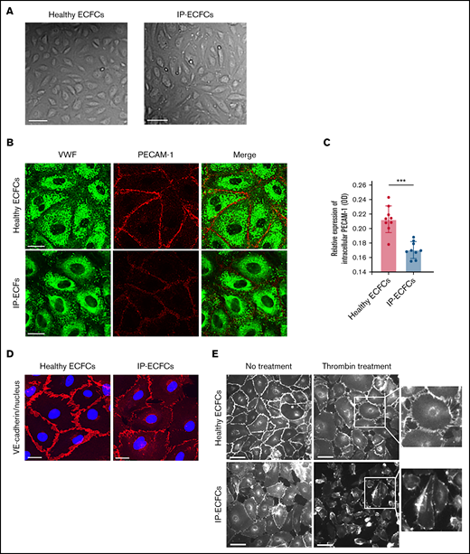 Endothelial cobblestone morphology and expression of endothelial cell adhesion proteins VE-cadherin and PECAM-1 at cell–cell junctions of ECFCs. (A) The typical endothelial cobblestone morphology of ECFCs isolated from a healthy individual and the IP. Scale bars, 100 µm. (B) VWF (green) and adherence junction protein PECAM-1 (red) are visualized with coimmunostaining of ECFCs derived from a healthy individual (upper) and patient (IP-ECFCs) (lower). Scale bars, 50 µm. (C) The intracellular level of PECAM-1 determined by in-cell ELISA assay (Abcam, UK). Cells of 3 healthy individuals and IP were seeded into collagen precoated 96-well microplate at a density of 2 × 104 cells/100 µL per well. Confluent ECFCs grown into 96-well plates were fixed, permeabilized, and stained with primary (CD31 antibody against PECAM-1) and horseradish peroxidase (HRP)-conjugated secondary antibodies. HRP-conjugated secondary antibodies were goat anti-mouse (Thermo Scientific, UK) and anti-rabbit (Abcam, UK) IgG. After the addition of the HRP-development solution, optical density at 650 (in a kinetic mode, within 60 minutes) was measured using a microplate reader (Synergy 2, BioTek). Last, The HRP signal of antibody-specific complexes was normalized to the Janus Green staining intensity to account for differences in cell density. Measurements were repeated for 3 independent experiments in triplicate (N = 9). Values are means ± SEM. ***P < .001 (unpaired Student t test). (D) ECFCs isolated from a healthy control (left) and the IP (right) were costained with antibodies recognizing VE-cadherin (red) and nucleus (DAPI staining, blue). The IP-ECFCs show defect in the expression of VE-cadherin at endothelial cell–endothelial cell junctions, associated with cytoplasmic red staining, indicating VE-cadherin internalization. Scale bars, 50 µm. (E) The response of the ECFCs to the thrombin stimulation by demonstrating gap formation between cells in the ECFCs monolayer. After thrombin treatment (10 nm, 5 minutes), cells were immunostained with an antibody targeted against VE-cadherin at endothelial cell junctions, and white-gray imaging was done by using inverted fluorescence microscopy. Scale bars, 100 µm. Boxes signify close-up views of VE-cadherin at cell-cell junctions.