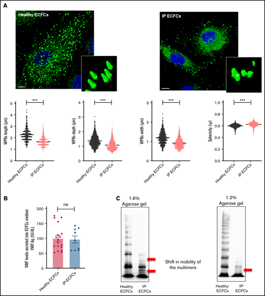 Intracellular storage and secretion of VWF in the ECFCs as well as expression of recombinant VWF in HEK293T cells. (A) Immunofluorescence images of ECFCs isolated from the IP and healthy individuals. In healthy ECFCs, VWF (green) is stored in rod-shaped organelles, resembling WPBs. However, VWF staining in the IP-ECFCs exhibited shorter WPBs than those observed in healthy ECFCs. The scale bar is 10 µm. Boxes signify close-up views of the processed 3D models of the WPBs granules surrounding with oriented bounds, generated by arivis Vision4D 3.2. The dot plot graphs demonstrate the quantitative morphological analysis of WPBs in healthy (black dot plot) and IP-ECFCs (pale red dot plot), including the average value of the longest (length), middle (depth), shortest sides (width), and sphericity factor (Ψ) of the selected 1000 WPBs. The sphericity factor, describing the roundness of the 3D granules, is represented as a value between 0 and 1, where 1 is an ideal sphere, and any particle that is not a sphere will have a sphericity < 1. IP-ECFCs demonstrated a decrease in length (1.69 ± 0.01 µm), depth (1.08 ± 0.01 µm), and width (0.91 ± 0.01 µm) of WPBs compared with wt (with an average length, depth, and width of 2.28 ± 0.01 µm, 1.37 ± 0.01 µm, and 1.2 ± 0.01 µm, respectively; P < .001). Furthermore, IP-ECFCs WPBs displayed a slightly increased sphericity value (0.61 ± 0.00 vs 0.59 ± 0.00 of wt WPBs; P < .001), favoring a less elongated shape. (B) The graph of the mean of VWF:Ag levels in the medium of ECFCs obtained from the IP (3 independent ECFCs isolation, each 3; N = 9) and 6 healthy donors (each 3 samples; N = 18). (C) The multimer profile of VWF in the supernatant of ECFCs analyzed by electrophoresis on 1.6% and 1.2% SDS-agarose gel. The multimer of VWF secreted from IP-ECFCs exhibited loss of large and intermediate multimers along with the shift in mobility of the small multimers (red arrows). (D) VWF:Ag levels (left) and VWF:GPIb (right) of secreted VWF into the medium of the transiently transfected HEK293T with huVWF (N = 9), huVWF/huVWF Del4-34 (coexpression at a ratio of 1:1; N = 9), and huVWF Del4-34 (N = 9) as well as untransfected cells (mock). (E) The multimer of recombinant VWF secreted into the medium of transfected huVWF, cotransfected huVWF/huVWF Del 4-34, and huVWF del 4-34 in HEK293T cell lines on 1.6% SDS-agarose gel. The multimer composition of secreted coexpressed huVWF/huVWF Del4-34 demonstrates the loss of large multimers along with a shift in mobility of the small multimers (red arrows) and homozygously expressed huVWF del 4-34 exhibited no multimer as expected. Error bars indicate the SEM. NS, not significant (P > .05); ***P < .001(unpaired Student t test).