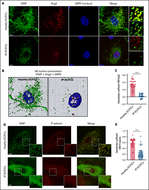 Impairment in the storage of the WPBs components, Ang2 and P-selectin, in patients’ endothelial cells. (A) Storage of VWF (green) and Ang2 (red) in WPBs was visualized by immunofluorescence staining of normal ECFCs (upper) and index patient ECFCs (IP-ECFCs; lower). The merge of green and red channels (with the focused region of interests) displays colocalization of VWF with Ang2 in healthy ECFCs, whereas strongly deficient VWF/Ang2 colocalization was perceived in IP-ECFCs. Scale bars, 10 µm. (B) The 3D topographic view of the merged channels of the ECFC images shown in panel A, generated by Zeiss Zen blue software. (C) The colocalization coefficients (of VWF and Ang2) were determined from at least 30 regions of interest from 2 independent experiments. (D) Fixed healthy ECFCs (upper) and IP-ECFCs (lower) were costained with antibodies detecting VWF (green) and P-selectin (red). The merge of green and red channels (with the focused regions of interest) demonstrates colocalization of VWF with P-selectin in healthy ECFCs, whereas IP-ECFCs show diminished colocalization of VWF/P-selectin. Scale bars, 20 µm. (E) Colocalization coefficients (of VWF and P-selectin) from at least 30 regions of interest from 2 independent experiments. Data are means ± SEM. ***P < .001 (unpaired Student t test).