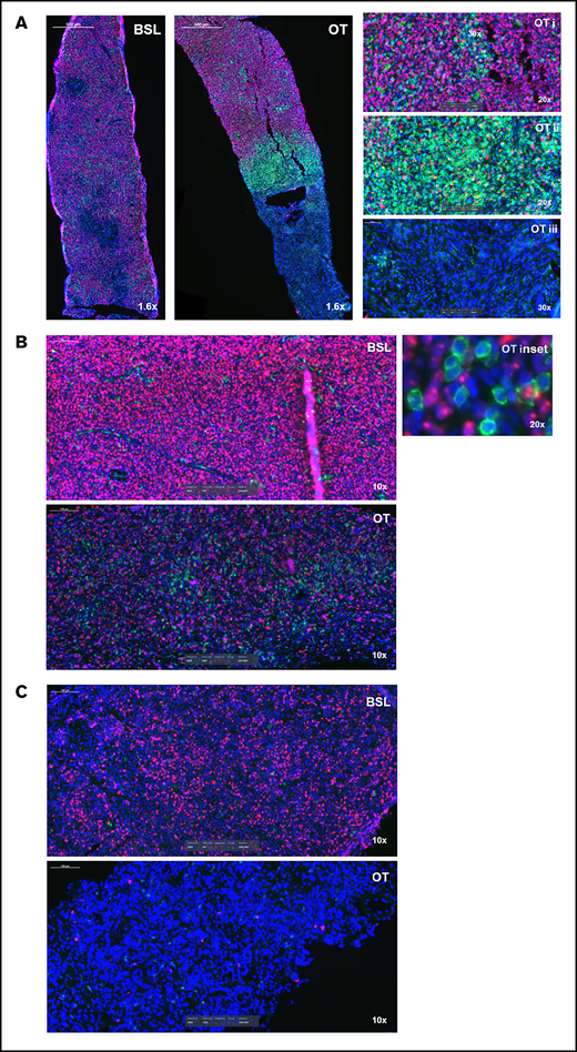 Glofitamab treatment induces spatial reorganization of CD8+ T cells in tumors. Images represent CD8+ (green), Ki67+ (pink), and 4′,6-diamidino-2-phenylindole (blue) immunofluorescence analysis of 3 DLBCL core biopsy specimens at baseline (BSL; before obinutuzumab pretreatment) and during treatment (OT). OT biopsy samples were taken on the first day of the second cycle (predose) (A and C) and on the eighth day of the third cycle (B). The insets in panel A indicate proliferative tumor cores (i), CD8+ T-cell area surrounding the core (ii), and area of necrosis (iii). The inset in panel B shows tumor cells (pink) interspersed and in close contact with CD8+ T cells (green). The OT biopsy in panel C is completely necrotic.