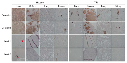 Effect of navtemadlin on systemic dissemination of EBV-positive PTLD lymphoma. Photomicrographs show representative immunohistochemical staining of human CD20 in the liver, spleen, lung, and kidney of 2 control-treated and navtemadlin-treated mice bearing TRL1 and TRL595 tumors. Tumor nodules and clusters of tumor cells were detected in all organs tested in all control mice. No tumor cells were detected in all organs tested in all navtemadlin-treated mice, except that microscopic nodules were observed in liver of TRL595 mice (arrow).
