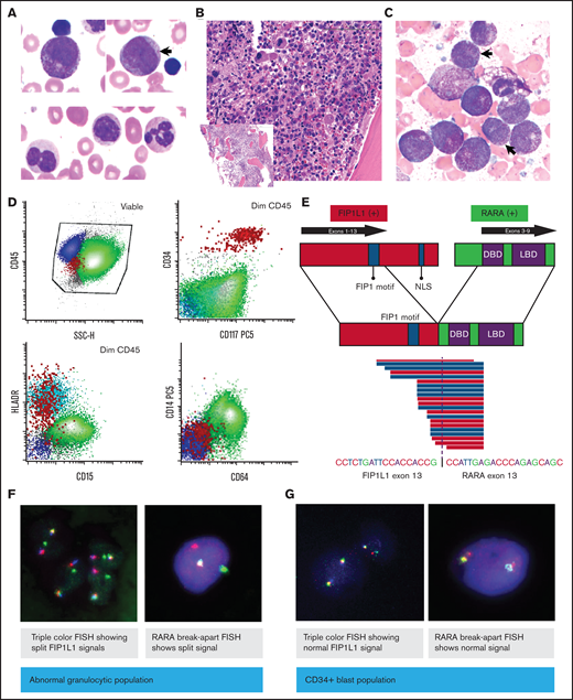 Peripheral blood and bone marrow evaluation of the patient’s leukemic cells at diagnosis. (A) Wright-Giemsa–stained peripheral blood smear (×100 magnification) at diagnosis, showing abnormal promyelocytes, immature myelomonocytic cells (arrow), and dysplastic neutrophils. (B) Hematoxylin and eosin–stained bone marrow biopsy (×20 magnification; inset ×4) at diagnosis. (C) Bone marrow aspirate smear (×100 magnification). Arrows indicate the dysplastic granulocytes. (D) Flow cytometry of diagnostic bone marrow aspirate. (E) Fusion schematic as identified by RNA sequencing. (F-G) Flow-sorted FISH: FIP1L1-RARA fusion was evaluated in granulocytic cells and CD34+ cells by triple color and RARA break-apart FISH. DBD, DNA-binding domain; LBD, ligand-binding domain; NLS, nuclear localization signal.