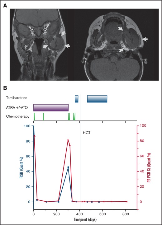 Imaging findings at the time of relapse and overall patient’s treatment course. (A) Magnetic resonance imaging of the skull at the time of relapse. Arrows indicate areas of disease. (B) Clinical treatment course (top axis) and disease burden as represented by FIP1L1-RARA fusion identified by FISH cells (left y-axis) and quantitative PCR (right y-axis).