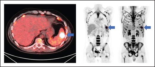 Axial fused, coronal PET-only, and maximum intensity projection images. Representative lesion segmented using 41% of SUVmax as cutoff (blue arrows).