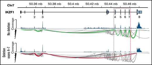 Detection of intragenic IKZF1 deletions by RNA-seq. Intragenic deletions of exons 4 to 7 of IKZF1 visualized using the GVIZ R package. Green line corresponds to normal IKZF1 transcript (IK1), and the red line corresponds to IK6 transcript missing exons 4 to 7 (example with patient #22).