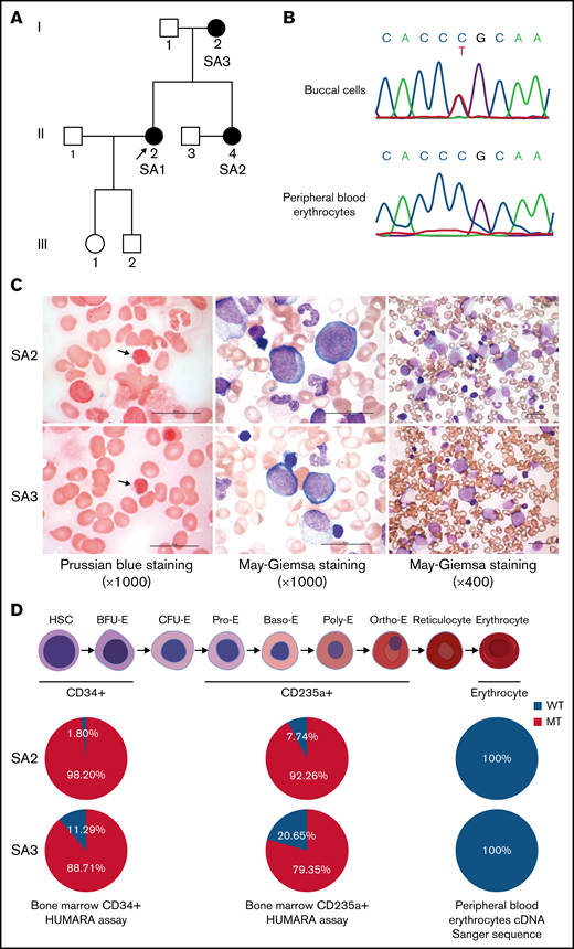 Identification of XLSA in a family harboring the heterozygous ALAS2-R227C mutation. (A) Pedigree of the family. Squares indicate males, and circles indicate females. Filled circles denote the patients confirmed by ALAS2 sequencing. The arrow indicates the proband. (B) Sanger sequencing data of ALAS2 genomic DNA from SA2 buccal cells (top) and ALAS2 cDNA from SA2 peripheral blood erythrocytes (bottom) are shown. (C) Morphology of SA2 and SA3 bone marrow cells. An increased number of ring sideroblasts was observed with Prussian blue staining (left). The arrows indicate ring sideroblasts. Megaloblastic change was detected by May Grunwald-Giemsa staining (middle and right). Magnification of the objective lens: ×100 (left and middle) and ×40 (right). Bars represent 25 μm. (D) Summary of HUMARA assays of CD34+ and CD235a+ bone marrow cells and ALAS2 cDNA Sanger sequencing of peripheral blood erythrocytes. The schematic diagram of erythropoiesis was created using BioRender.com. cDNA, complementary DNA.