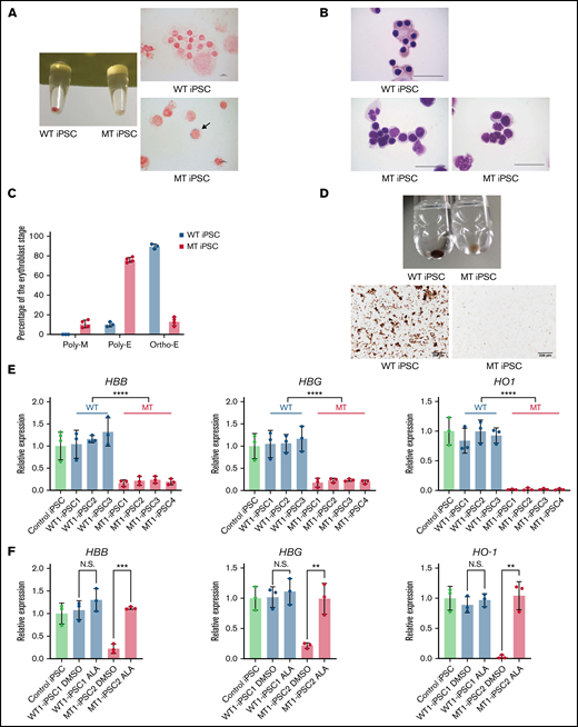 Maturation defects of erythroblasts derived from MT iPSCs. (A) The pellets (left) and iron staining (right) of erythroblasts derived from WT1-iPSC2 and MT1-iPSC3. The arrow indicates a ring sideroblast. CD235a+ cells were sorted on day 34 by FACS. Magnification of the objective lens: ×100. Bars represent 10 μm. (B) May Grunwald-Giemsa staining of erythroblasts derived from WT1-iPSC2 (top) and MT1-iPSC4 (bottom). CD235a+ cells were sorted on day 34 by FACS. Magnification of the objective lens: ×100. Bars represent 25 μm. (C) Percentages of polychromatic megaloblasts (Poly-M), polychromatic erythroblasts (Poly-E), and orthochromatic erythroblasts (Ortho-E) from 3 WT and 4 MT iPSC lines. (D) The pellets (top) and photomicrographs (bottom) of o-dianisidine–stained erythroblasts derived from WT1-iPSC3 and MT1-iPSC3 (bottom). CD235a+ cells were sorted on day 34 by FACS. Magnification of the objective lens: ×10. Bars represent, 200 μm. (E) The expression levels of HBB, HBG, and HO1 genes in erythroblasts derived from 1 control iPSC line, 3 WT iPSC lines, and 4 MT iPSC lines. Each line was tested in 3 independent experiments. Expression levels were normalized to the level of GAPDH. (F) The expression levels of HBB, HBG, and HO1 genes in WT1-iPSC1– and MT1–iPSC2-derived erythroblasts treated with DMSO or ALA relative to the expression levels of nontreated erythroblasts derived from a control iPSC line. Each line was tested in 3 independent experiments. Expression levels were normalized to the level of GAPDH. All data are presented as the mean ± standard error of the mean. P-values were calculated by using the unpaired, 2-tailed Student t test. **P < .01; ***P < .001; ****P < .0001; N.S., not significant. DMSO, dimethyl sulfoxide.