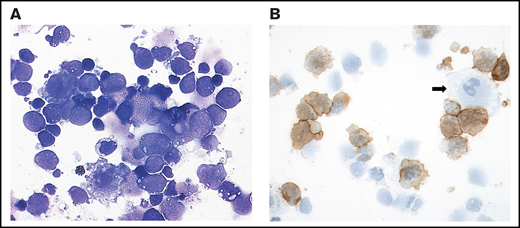 Cytological features of VRL: case 3. (A) The cytospin shows a cellular vitreous aspirate with large, atypical cells with irregular nuclei, frequent prominent nucleoli, and basophilic cytoplasm containing vacuoles admixed with small lymphocytes. Degenerative changes with frequent cell shadows are evident. May Grunwald-Giemsa stain, original magnification ×400. (B) CD20 staining of many atypical cells. The negative cells are likely to be T cells, macrophages (arrow), or degenerated tumor cells lacking preserved membrane staining. Immunoperoxidase; original magnification ×400.