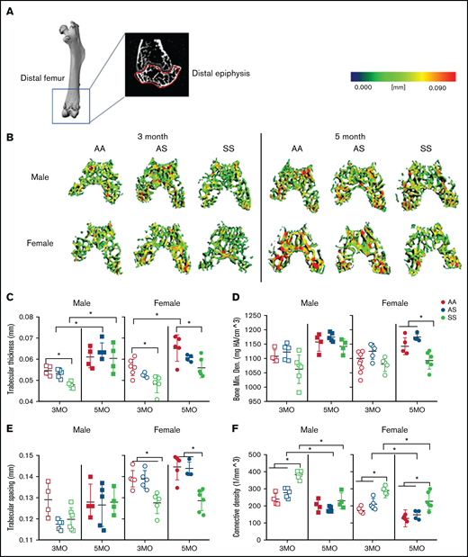 Sex-specific differences in SCD-mediated reduction of trabecular bone in distal epiphysis of mice at 3 and 5 months. (A) Representative microCT image of an entire femoral bone, including a microCT scan of the distal femur with the distal epiphysis outlined in red. (B) Representative three-dimensional heat maps of trabecular morphology in the epiphyseal region of the distal femur in AA, AS, and SS in 3-month-old (left) and 5-month-old (right) male and female mice. A pseudocolor scale of blue (0 mm) to red (0.09 mm) depicts trabecular thickness. Trabecular bone parameters generated by microCT scans include: trabecular thickness (C); BMD (D); trabecular spacing (E); and connective density (F). AA = black, AS = gray, SS = red. Data are expressed as mean ± standard deviation. Statistical significance, *P < .05, determined by two-way analysis of variance with Tukey’s post hoc test; n = 4 to 6 mice per group; scale bar, 100 μm. Bone Min. Den., BMD; HA, hydroxyapatite.