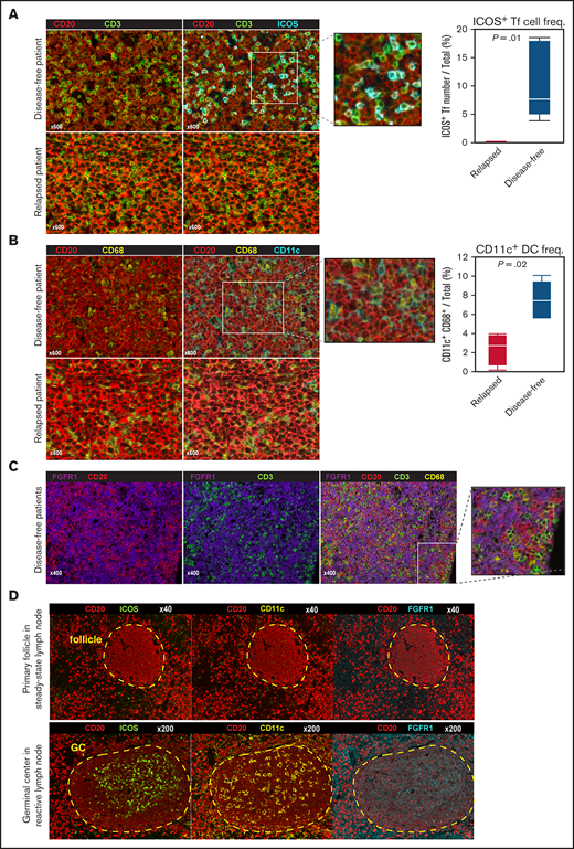 Identification of microenvironmental cell subtypes by single-cell expression profiling and imaging analysis. (A) Left, detection of follicular T (Tf) cells in DLBCL tissue based on indicated markers using multiplexed immunofluorescence imaging analysis and the Mantra system. Representative images taken from 10 patient samples analyzed are shown. We assigned each fluorescent signal to the preset pseudocolor (CD20: red; CD3: green; ICOS: cyan). Most CD3+ T cells (green) express ICOS protein (cyan) in disease-free cases, while not in relapsed cases. Note that the frequencies of CD20+ lymphoma B cells (red) and overall CD3+ T cells (green) were comparable between them. Right, Box and Whisker plot (dots indicate outliers) shows frequency of ICOS+ Tf cells, which were digitally counted in 5 fields. P values were calculated using the Wilcoxon rank-sum test. (B) Left, comparable imaging identified CD68+ DCs/macrophages (yellow) expressed CD11c (cyan) in favorable prognostic case. Note that CD68+ DC/macrophages (yellow) did not express CD11c in relapsed cases. Right, the proportion of CD11c+ CD68+ cells among total cells in 5 fields, shown as a Box and Whisker plot (dots indicate outliers), in relapsed vs disease-free cases, as calculated by the Wilcoxon rank-sum test. (C) Characterization of FGFR1+ cells (purple) based on staining with the lineage-specific markers CD3 (T cells), CD68 (DC/macrophages), and CD20 (B cells). (D) Multispectral imaging shows steady-state LN (upper) and reactive LN (lower) specimens stained with indicated markers. ICOS, CD11c, and FGFR1 are enriched during GC formation.