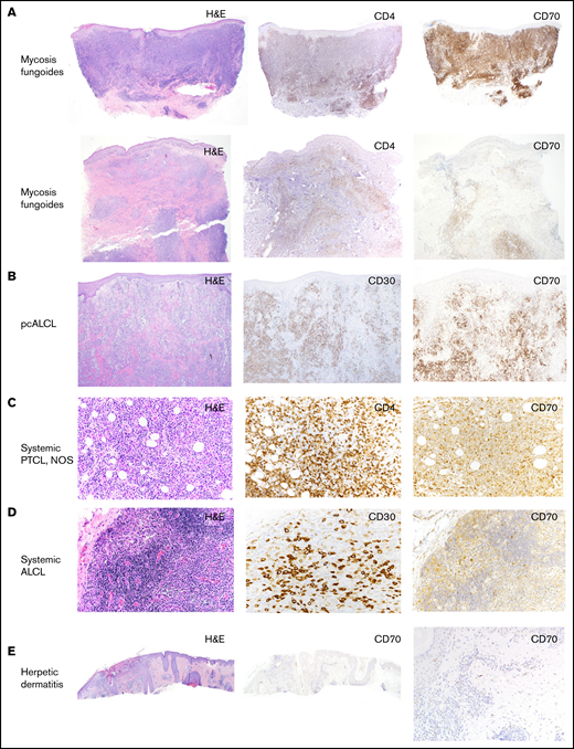 CD70 expression in different subtypes of T-cell lymphomas. (A) Representative images of hematoxylin/eosin (H/E), IHC stains of CD4 and CD70 in 2 skin biopsies of MFs, showing different levels of CD70 expression (original magnification, ×40). (B) Representative images of H/E, IHC stains of CD30 and CD70 in a skin biopsy of a patient with pcALCL (original magnification, ×40). (C) Representative images of H/E, IHC stains of CD4 and CD70 in a lymph node biopsy of PTCL, NOS (original magnification, ×20). (D) Representative images of H/E, IHC stains of CD30 and CD70 in a lymph node biopsy of systemic ALCL (original magnification, ×20). (E) Images of H/E and IHC stain of CD70 in a skin biopsy of herpetic dermatitis, showing negative CD70 expression (original magnification, ×40).