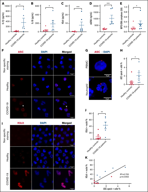 Circulating neutrophils from COVID-19 pneumonia patients demonstrate inflammasome activation and high nuclear citrullination. Plasma samples from healthy controls (n = 8) and patients with severe COVID-19 (n = 6) were evaluated for: (A) IL-1β, (B) IL-18, (C) H3cit, (D) dsDNA, and (E) MPO-DNA complexes. Values are means plus or minus SEM. Data were analyzed using Mann-Whitney U test; *P < .05, ***P < .0001. Neutrophils freshly isolated from healthy controls and patients with severe COVID-19 were stained with DAPI (blue) and (F) an anti-ASC antibody (red) or (I) with an anti-H3cit antibody (red). White arrows indicate the presence of the ASC speck. Nonspecific staining corresponds to immunostaining performed without primary antibodies. (F) Representative images from widefield microscopy of neutrophils. Scale bar, 10 μm. (G) Representative confocal microscopy images of an immunostained neutrophil and a PBMC from COVID-19 patient. Blue, DNA (DAPI); red, ASC antibody staining. Scale bar, 5 µm. (H) Quantification of neutrophils presenting a speck. (I) Representative images from widefield microscopy of neutrophils. Scale bar, 10 μm. (J) Quantification of neutrophils with nucleus positive for H3cit. Each dot represents 1 individual. Values are means plus or minus SEM. Data were analyzed by Mann-Whitney U test; *P < .005, **P < .001. (K) Correlation between the percentage of neutrophils positive for H3cit and percentage of neutrophils forming speck among all individuals healthy (▪) and COVID-19 patients (•). A nonparametric Spearman correlation test was computed. dsDNA, double-stranded DNA; H3cit, citrullinated histone H3; MPO-DNA, myeloperoxidase‐DNA; SEM, standard error of the mean.