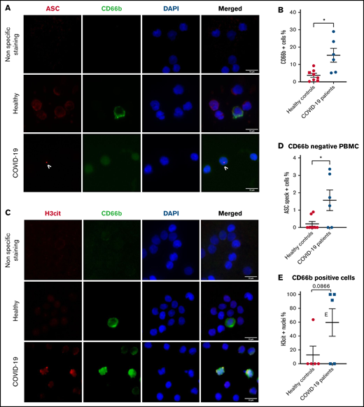 PBMCs from severe COVID-19 patients form ASC speck at similar frequency to neutrophils. PBMCs were stained with DAPI (blue), an anti-CD66b antibody (neutrophil marker, green) and (A) an anti-ASC antibody (red), or (C) with an anti-H3cit antibody (red). (A) Representative images from widefield microscopy of PBMCs. Scale bar, 10 μm. (B) Quantification of CD66b+ cells (neutrophils) in PBMC fraction. (C) Representative images from widefield microscopy of PBMCs. Scale bar, 10 μm. (D) Quantification of CD66b− cells presenting a speck. (E) Quantification of CD66b+ cells (neutrophils) with nucleus positive for H3cit. Each dot represents 1 individual. Values are means plus or minus SEM. Data were analyzed by Mann-Whitney U test; *P < .05. SEM, standard error of the mean.