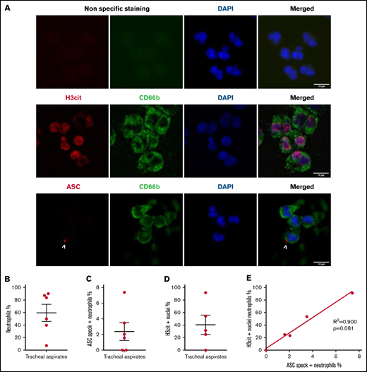 Neutrophils recruited to the lung in patients with COVID-19 pneumonia have inflammasome activation and are predisposed to NETosis. Smears of tracheal aspirates were costained with DAPI (blue), an anti-CD66b antibody (neutrophil marker, green) and an anti-ASC antibody (red), or with an anti-H3cit antibody (red). Nonspecific staining corresponds to immunostaining performed without primary antibodies. (A) Representative images from widefield microscopy of tracheal aspirates from severe COVID-19 patients. White arrows indicate the presence of the ASC speck. Scale bar, 10 µm. (B) Quantification of CD66b+ neutrophils in tracheal aspirates. (C) Quantification of ASC speck–positive neutrophils in tracheal aspirates. (D) Quantification of H3cit+ neutrophils in tracheal aspirates. (E) A nonparametric Spearman correlation test was computed. SEM, standard error of the mean.