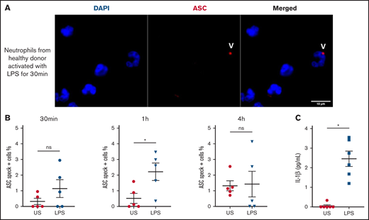 Human neutrophils activate inflammasome early after LPS activation. Neutrophils isolated from healthy individuals (n = 5) were activated for different lengths of time with 5 μg/mL of LPS and stained with DAPI (blue) and an anti-ASC antibody (red). (A) Representative images from widefield microscopy of neutrophils activated for 30 minutes with 5 μg/mL of LPS. White arrows indicate the presence of the ASC speck. Scale bar, 10 μm. (B) Quantification of neutrophils presenting a speck at 30 minutes, 1 hour, and 4 hours after LPS activation. (C) IL-1β concentration measured in the supernatant of unstimulated (US) neutrophils or activated with LPS. Each dot represents 1 individual. Values are means plus or minus SEM. Data were analyzed by Mann-Whitney U test; *P < .05. SEM, standard error of the mean