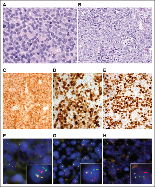 Morphological, immunophenotypic, and genetic features of triple-positive DLBCLs. (A) B-cell lymphoma with blastic morphology characterized by medium- to large-sized cells with irregular nuclei, fine chromatin, inconspicuous nucleolus, and scant cytoplasm (case 10), (original magnification ×400; hematoxylin and eosin stain). (B-G) Case 5 shows a characteristic centroblastic morphology (original magnification ×400; hematoxylin and eosin stain). The tumor cells are CD10+ (C), MUM1/IRF4+ (D), and BCL6+ (E) (original magnification ×400; immunostaining). FISH demonstrates an IRF4 (F) and IGL (G) break with 1 colocalized signal (yellow arrow) and 1 split signal (green and red arrows) consistent with gene rearrangement. (H) In case 2, an IGK break was demonstrated. FISH shows a signal constellation of 1 colocalized signal (yellow arrow) and 1 split signal (green and red arrows) consistent with gene rearrangement.
