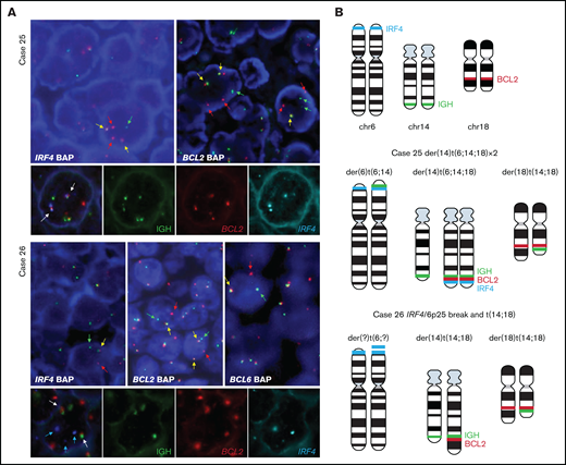 FISH analysis demonstrates complex rearrangement with IRF4 and BCL2/BCL6 genes. (A) FISH analyses using IRF4, BCL2, and BCL6 break-apart probes and triple-color FISH for IGH, BCL2, and IRF4 loci in the 2 cases with IRF4 rearrangement together with BCL2 in case 25 and BCL2/BCL6 rearrangement in case 26. These hybridizations were performed using t(14;18) dual-color fusion (Metasystems) and BAC clones spanning IRF4 locus (BAC clones 5' RP3-416J7 and 3' RP5-1077H22 and RP5-856G1) labeled in spectrum aqua. Red signals correspond to BCL2, green signals correspond to IGH, and aqua/blue signals represent IRF4. Case 25. FISH demonstrates IRF4 and BCL2 breaks (upper panel) with 1 or 2 colocalized signals (yellow arrows) and 1 or 2 split signals (green and red arrows) consistent with BCL2 and IRF4 gene rearrangement. The triple rearrangement (IGH-IRF4-BCL2) (lower panel) is demonstrated by colocalization of the 3 colors (white arrows). Case 26. FISH analysis for IRF4, BCL2, and BCL6 with break-apart probes demonstrates 1 colocalized signal (yellow arrow) and 1 split signal (green and red arrows), indicating a triple rearrangement. FISH analyses of concomitant IGH, BCL2 and IRF4 rearrangements (lower panel) show 2 colocalized signals (white arrow) of the derivative chromosomes 14 and 18 resulting in t(14;18) translocation. IRF4 locus (blue arrows) did not colocalize with either the IGH locus or the t(14;18) translocation, indicating that this is an independent rearrangement with unknown partner. (B) Schematic representation of IRF4 (aqua blue), IGH (green), and BCL2 (red) breaks/rearrangements in cases 25 and 26.