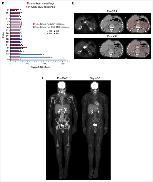 Sites of non-CNS EMD and response to CAR T cells. (A) Patients with non-CNS EMD identifiable during retrospective central review. (B) Manifestations of non-CNS EMD (by percentage of patients) identified during central review of FDG PET/CT imaging from 38 patients screened across multiple early-phase trials at our institution over an 8-year period. (C) Non-CNS EMD in the cohort of 17 patients (18 infusions) who obtained serial FDG PET/CT images pre– and post–CAR T-cell infusion, with sites of non-CNS EMD exhibiting a CR to CAR T cells represented in blue. (D) Time to best response of medullary/non-CNS EMD in the cohort of 17 patients (18 infusions) who obtained serial FDG PET/CT images pre– and post–CAR T-cell infusion. (E) FDG PET/CT scans obtained pre– and post–CD19/22 CAR T-cell infusion showing a discrepant medullary/non-CNS EMD response. Patient 14 attained a medullary MRD-negative CR but exhibited non-CNS EMD PD, with new and worsening sites of non-CNS EMD identified in the adrenal gland, retroperitoneal lymph node, pancreas, and testes ∼1 month post–CAR T-cell infusion. (F) FDG PET/CT scans obtained pre– and post–CD19/22 CAR T-cell infusion showing a concurrent CR of medullary/non-CNS EMD at best response. Patient 13 presented to our institution with multifocal non-CNS EMD involving the lymph nodes, mediastinum, kidneys, and pancreas. NCI, National Cancer Institute; SD, stable disease.