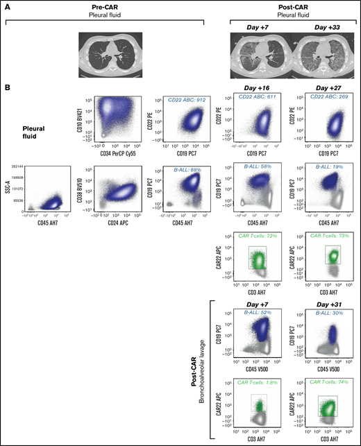 Unique CAR T cell–associated toxicities and CAR T-cell expansion in select patients (n = 2) with non-CNS EMD. (A) CT scans obtained pre– and post–CD22 CAR infusion showing CAR T cell–associated pulmonary toxicity in a subject (Patient 6) with pleural-based non-CNS EMD. Clinically, CAR T-cell trafficking to non-CNS EMD was evidenced by development of new pleural effusions, ground-glass opacities, and oxygen requirement. (B) Corresponding flow cytometry of pleural fluid before CD22 CAR infusion identified B-ALL comprising 88% of mononuclear cells (MNCs). B-ALL blasts (navy blue) expressed slightly dim CD45, CD19, CD10, partial CD34, CD22, dim CD38, and CD24. CD22 antibody-binding capacity (ABC) was 912, a quantitative measure of antigen site density on the blast cell surface. Subsequently, flow cytometry performed at day +16 post–CD22 CAR infusion showed an expansion of CD22 CAR T cells (green), comprising 72% of T cells, which persisted at day +27. The amount of B-ALL disease decreased to 58% of MNCs and 19% of MNCs at day +16 and day +27, respectively. CD22 ABC decreased posttherapy from 912 to 611 and 269 at day +16 and day +27, respectively. Flow cytometry was also performed on bronchoalveolar lavage post–CAR infusion. The amount of B-ALL disease decreased from 52% of MNCs at day +7 to 30% of MNCs at day +31. At day +7, 1.8% of T cells were CD22 CAR T cells (green); they expanded to comprise 74% of T cells at day +31. (C) CT scans obtained pre– and post–CD22 CAR infusion in a subject (Patient 39) with pleural-based disease exhibiting delayed resolution (day +83) of CAR T cell–associated inflammatory toxicities. (D) Corresponding flow cytometry of pleural fluid before CD22 CAR T-cell therapy identified B-ALL comprising 86% of MNCs. B-ALL blasts (navy blue) expressed a spectrum of CD45 from dim to negative, bright CD10, CD34, CD22, and dim CD38; they were negative for CD19 and CD24. The CD22 ABC was 2594. As expected, no CAR T cells were detected by using the flow cytometry assay. Subsequently, flow cytometry was performed on a bronchoalveolar lavage specimen at day +54 post–CD22 CAR infusion. Expansion of CD22 CAR T cells was detected (green), comprising 85% of T cells, and there was no evidence of B-ALL. Notably, Patient 39 did not have non-CNS EMD identifiable on FDG PET/CT imaging during central review and was not included in the initial study cohort. (E) Generalized approach to indications for evaluation of non-CNS EMD in the peri–CAR T-cell setting. SSA, side scatter area.