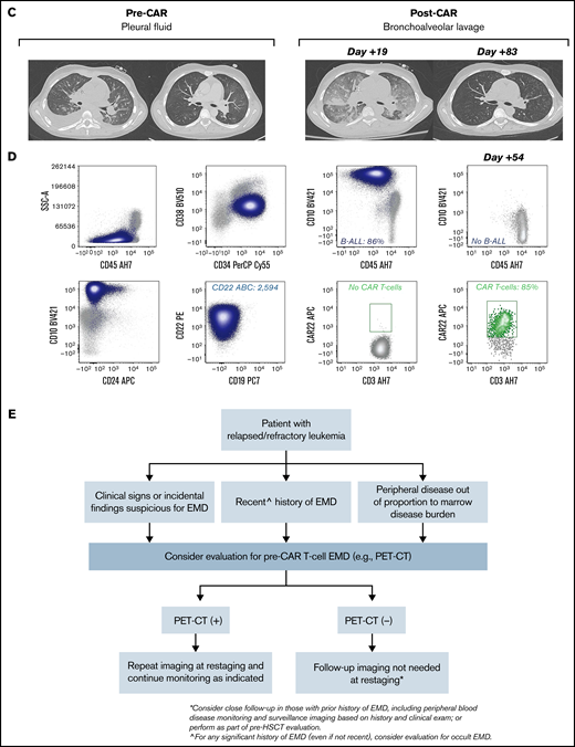 Unique CAR T cell–associated toxicities and CAR T-cell expansion in select patients (n = 2) with non-CNS EMD. (A) CT scans obtained pre– and post–CD22 CAR infusion showing CAR T cell–associated pulmonary toxicity in a subject (Patient 6) with pleural-based non-CNS EMD. Clinically, CAR T-cell trafficking to non-CNS EMD was evidenced by development of new pleural effusions, ground-glass opacities, and oxygen requirement. (B) Corresponding flow cytometry of pleural fluid before CD22 CAR infusion identified B-ALL comprising 88% of mononuclear cells (MNCs). B-ALL blasts (navy blue) expressed slightly dim CD45, CD19, CD10, partial CD34, CD22, dim CD38, and CD24. CD22 antibody-binding capacity (ABC) was 912, a quantitative measure of antigen site density on the blast cell surface. Subsequently, flow cytometry performed at day +16 post–CD22 CAR infusion showed an expansion of CD22 CAR T cells (green), comprising 72% of T cells, which persisted at day +27. The amount of B-ALL disease decreased to 58% of MNCs and 19% of MNCs at day +16 and day +27, respectively. CD22 ABC decreased posttherapy from 912 to 611 and 269 at day +16 and day +27, respectively. Flow cytometry was also performed on bronchoalveolar lavage post–CAR infusion. The amount of B-ALL disease decreased from 52% of MNCs at day +7 to 30% of MNCs at day +31. At day +7, 1.8% of T cells were CD22 CAR T cells (green); they expanded to comprise 74% of T cells at day +31. (C) CT scans obtained pre– and post–CD22 CAR infusion in a subject (Patient 39) with pleural-based disease exhibiting delayed resolution (day +83) of CAR T cell–associated inflammatory toxicities. (D) Corresponding flow cytometry of pleural fluid before CD22 CAR T-cell therapy identified B-ALL comprising 86% of MNCs. B-ALL blasts (navy blue) expressed a spectrum of CD45 from dim to negative, bright CD10, CD34, CD22, and dim CD38; they were negative for CD19 and CD24. The CD22 ABC was 2594. As expected, no CAR T cells were detected by using the flow cytometry assay. Subsequently, flow cytometry was performed on a bronchoalveolar lavage specimen at day +54 post–CD22 CAR infusion. Expansion of CD22 CAR T cells was detected (green), comprising 85% of T cells, and there was no evidence of B-ALL. Notably, Patient 39 did not have non-CNS EMD identifiable on FDG PET/CT imaging during central review and was not included in the initial study cohort. (E) Generalized approach to indications for evaluation of non-CNS EMD in the peri–CAR T-cell setting. SSA, side scatter area.