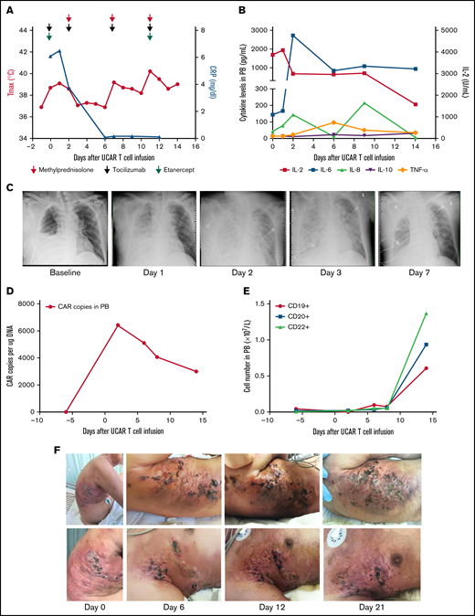 Toxicities, persistence, and response in patient 1 after administration of universal CAR T cells. (A) The change in maximum temperature (Tmax) and the serum level of C-reactive protein (CRP) were tested in patient 1 before and after universal CAR (UCAR) T-cell infusion and CRP recovery after multicycle of methylprednisolone (red arrow), tocilizumab (light green arrow), and etanercept (purple arrow) administration. (B) The serum levels of cytokines, including interleukin-2 (IL-2), IL-6, IL-8, IL-10, and tumor necrosis factor-α (TNF-α), were tested after UCAR T-cell infusion. (C) Chest X-ray showed the appearance of acute pulmonary edema after UCAR T-cell infusion. (D) Persistence of infused UCAR T cells in patient peripheral blood (PB) before and after cell infusion. The level of UCAR T cells was analyzed using quantitative polymerase chain reaction to detect the CAR gene copy number in genomic DNA obtained from PB of patient 1. (E) The change in B-cell number before and after UCAR T-cell infusion. (F) Skin damage in the right trunk developed after UCAR T-cell infusion. The swelling improved after methylprednisolone treatment.