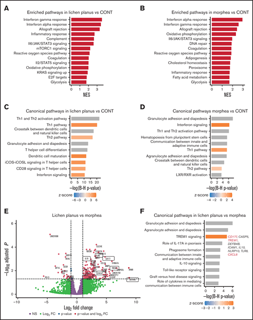 Common and specific molecular features of LP and morphea cGVHD. GSEA for “hallmark gene set” for LP (n = 8) vs healthy controls (CONT, n = 6) (A) and for morphea (n = 5) vs CONT (n = 6) (B). (C-D) Relevant canonical pathways using IPA differentiating (C) LP (n = 8) vs control (CONT) and (D) morphea (n = 5) cGVHD skin lesions VS CONT (n = 6). Pathways identified are represented on the y-axis. The x-axis corresponds to the –log of the P value. Orange, z-score value is positive (>0), pathway is predicted to be activated; blue, z-score value is negative (<0), pathway is predicted to be inhibited; gray, no activity pattern available. (E) Volcano plot with log2FC and −log10 P values for the DEGs comparing LP (n = 8) vs morphea (n = 5) chronic cGVHD skin lesions. The most statistically significant genes are toward the top and are depicted in red. Genes of interest are encircled. (F) Relevant canonical pathways using IPA differentiating LP (n = 8) vs morphea (n = 5) cGVHD skin lesions, with upregulated DEGs in the TREM1 signaling pathway. Pathways identified are represented on the y-axis. The x-axis corresponds to the –log of the P value. Orange, z-score value is positive (>0), pathway is predicted to be activated; blue, z-score value is negative (<0), pathway is predicted to be inhibited; gray, no activity pattern available.
