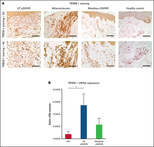 IHC testing and RT-qPCR in patients with LP and morphea cGVHD. (A) TREM-1 IHC labeling of skin biopsies of LP (left panels) chronic graft-versus-host disease (cGVHD), morphea cGVHD (middle right panels), and healthy controls (right panels). Abdominal aorta atherosclerosis was used as positive control. Scale bar, 200 mm for panels at ×20; scale bar, 100 mm for panels at ×40; arrows indicate some of the TREM-1+ macrophages. (B) Bar graph showing TREM-1 mRNA expression by using RT-qPCR in healthy controls (n = 5), lichen cGVHD (n = 6), and morphea cGVHD (n = 5). *P < .05.