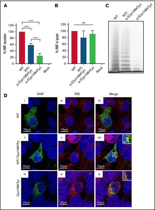 Defective secretion despite normal storage of p.(Cys1084Tyr) VWF in vitro. (A) HEK293T cells were transiently transfected with cDNA encoding WT-VWF, the p.(Cys1084Tyr) variant, or a 1:1 molar ratio of both constructs to mimic the heterozygous state. Transfection with cDNA encoding the p.(Cys1084Tyr) variant led to a significant reduction in the amount of VWF secreted into the conditioned media whether transfected alone or cotransfected with the cDNA coding for WT-VWF. The reduction in VWF secretion was more severe for the transfection mimicking the homozygous condition. Data are represented as mean ± standard error of the mean (SEM), ****P < .0001. (B) No increase in variant VWF was observed in the cellular lysate for either the heterozygous or homozygous state indicating that the p.(Cys1084Tyr) variant does not cause intracellular retention of VWF. (C) Multimer analysis of recombinant VWF showed a relative reduction in high-molecular-weight multimers for VWF produced via cotransfection and a complete absence of high- and intermediate-weight multimers for p.(Cys1084Tyr) VWF. (D) Pseudo-WPB formation was assessed via transient transfection in HEK293 cells. Transfected cells were fixed and stained for VWF (green; i, ii, iii) and resident ER protein protein disulfide isomerase (PDI) (red; iv, v, vi). Merged images (vii, viii, ix) are shown in the final column. For all images, blue indicates 4′,6-diamidino-2-phenylindole. Colocalization of VWF and PDI was observed for cotransfected cells (viii) and for cells transfected with p.(Cys1084Tyr)-VWF alone (ix). Magnified views of regions of colocalization are shown in the inset. Images are representative of n = 3 independent experiments.